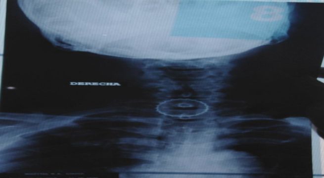 Hombre de 67 años tiene una chapa de cerveza en el esófago desde hace 3 días