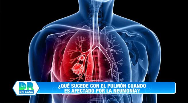 Doctor en Casa: Aprendamos todo sobre la neumonía