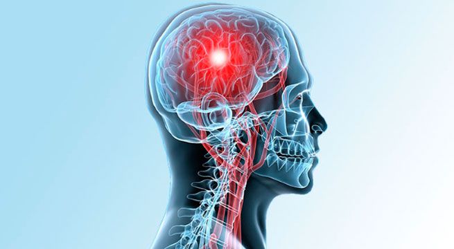 Doctor en Casa: conoce todo sobre el accidente cerebrovascular