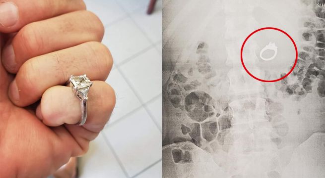Mujer se traga anillo de compromiso mientras dormía y termina en el hospital [VIDEO]