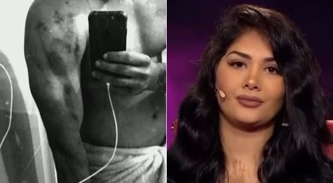Expareja de Chris Soifer muestra pruebas de maltrato físico en su contra