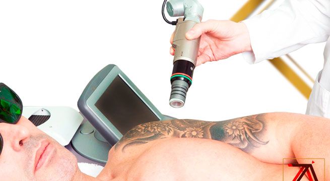 Conoce un novedoso tratamiento para eliminar los tatuajes