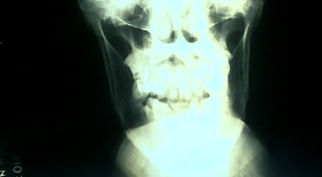 San Juan de Lurigancho: dientes comprobarán identidad de cadáver hallado en cilindro