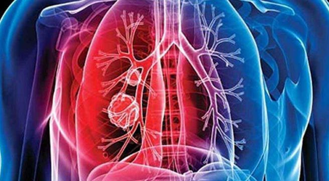Día de la Tuberculosis: 4 Consejos alimenticios para prevenir el contagio o superar la tuberculosis