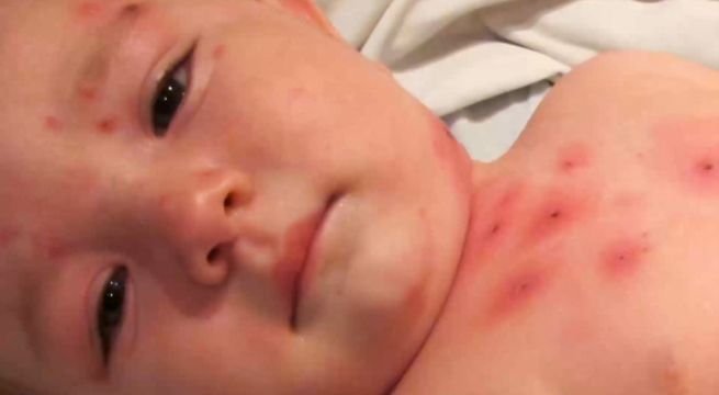 Perú se encuentra preparado para afrontar un posible brote de sarampión