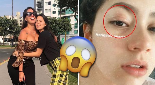 Hija de Melissa Klug cuenta que fue golpeada en el rostro durante una fiesta [FOTO]
