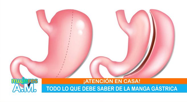 Mujeres al Mando: Todo lo que debes saber de la manga gástrica