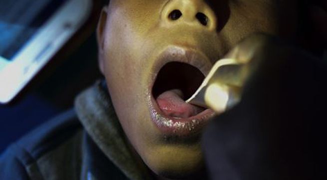 Difteria: ¿qué es, cómo se contagia y quiénes corren peligro al tenerla?