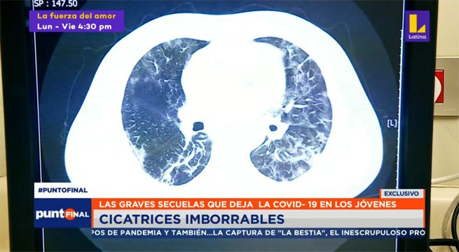 Las graves secuelas que deja el Covid-19 en los jóvenes