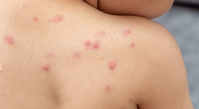 Viruela del mono: se elevan a 2.337 casos acumulados, según Minsa