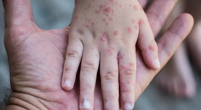 Viruela del mono: suben a 2.383 los casos acumulados en Perú