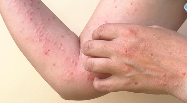 Viruela del mono: Perú cerca de superar los 2.000 casos acumulados