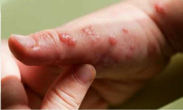 Viruela del mono: casos acumulados en Perú aumentan a 1.300