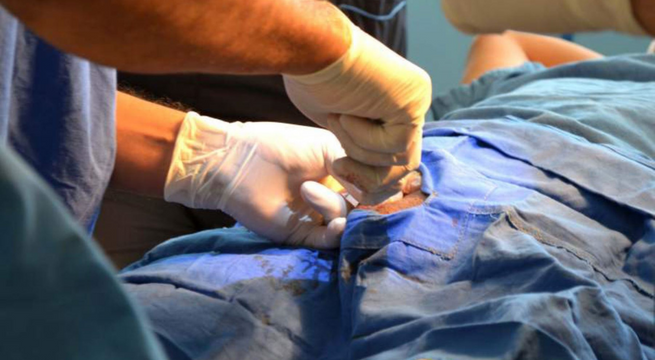 Ministerio de Salud realizará vasectomías gratuitas desde el 14 al 18 de noviembre