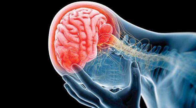 El derrame cerebral: un enemigo silencioso que puede prevenirse