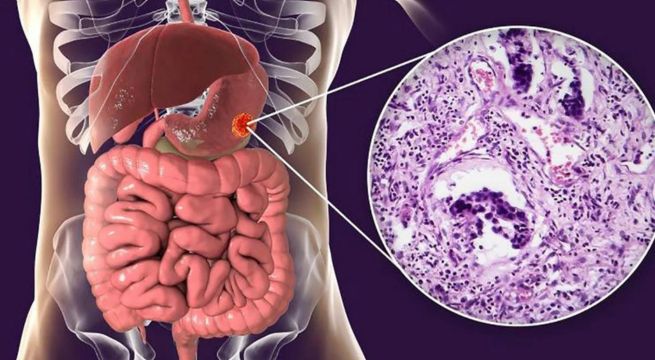 Cuáles son los síntomas que podrían indicar la presencia de cáncer