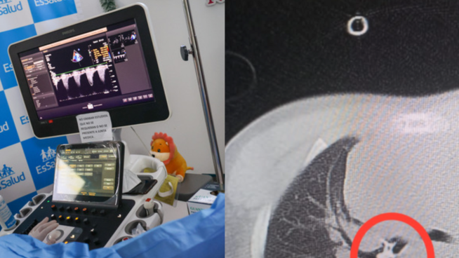 Essalud salva a niño de 6 años que tenía un diente en el pulmón