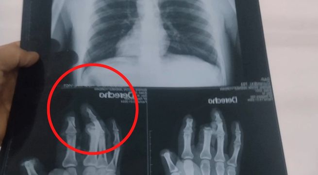 Acusado de extorsión pierde los dedos de la mano tras manipular un explosivo