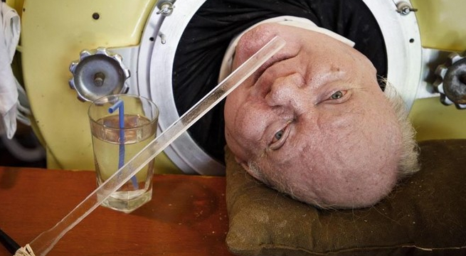 Víctima de polio vive dentro de 