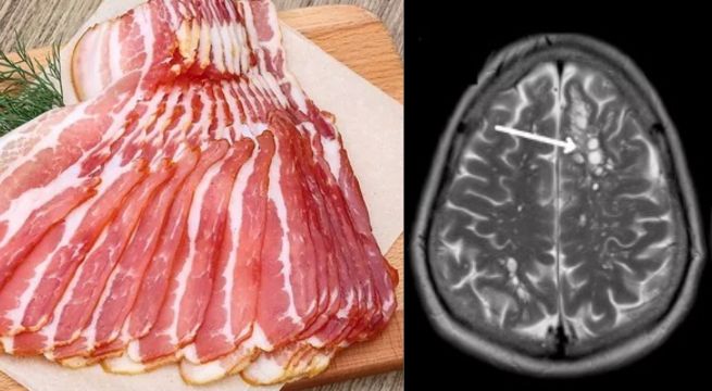 Presentaba migrañas y le encontraron huevos de gusanos en el cerebro: Hombre había consumido tocino poco cocido