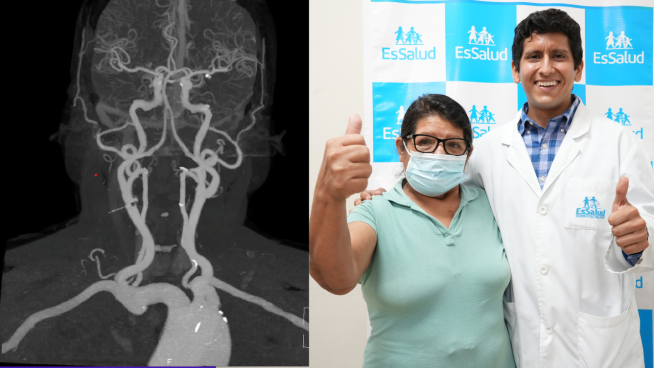 EsSalud salva la vida a mujer que tragó un clavo dentro de un chicharrón