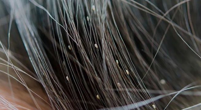 Trucos caseros: cómo eliminar piojos de manera rápida y sencilla