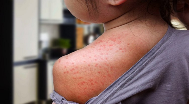 ¿Alergia al agua? Esto es lo que se sabe de la extraña condición