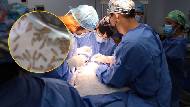 Extraen más de 100 larvas a paciente: estaban alojadas en el interior de la cavidad bucal