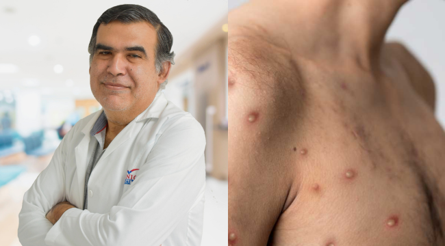 Viruela del mono en Piura: estas son las medidas preventivas que debes seguir