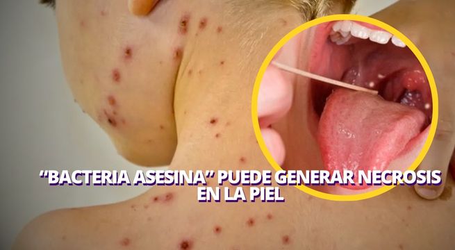 La 'bacteria asesina' que alertó a Chile y Japón ya está en Perú: Conoce todos los síntomas y cómo prevenirla