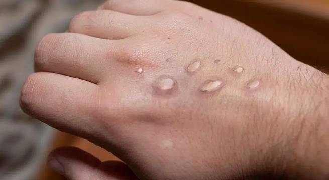 Minsa alerta sobre riesgo de introducción de la 'Viruela del Mono' en el Perú