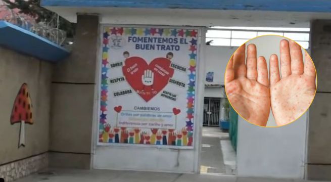 Junín activa protocolos tras nuevos casos de mano, pie y boca en alumnos de inicial
