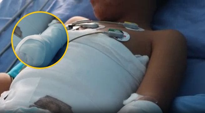 Niño de 8 años sufre amputación de su mano tras exposión de un pirotécnico