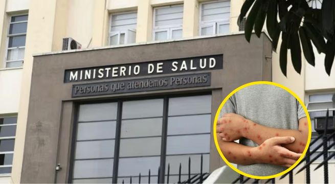 Minsa confirma cuatro casos de sarampión en Lima: pacientes se encuentran fuera de peligro