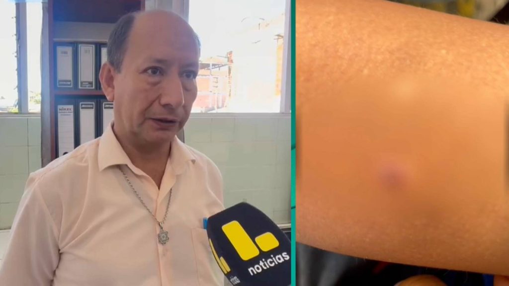 Se confirmaron más de 500 casos del virus coxsackie en esta región peruana