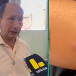 Se confirmaron más de 500 casos del virus coxsackie en esta región peruana