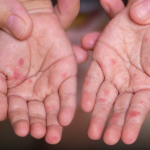 Alerta sanitaria por virus infantil: piden reforzar higiene y prevención