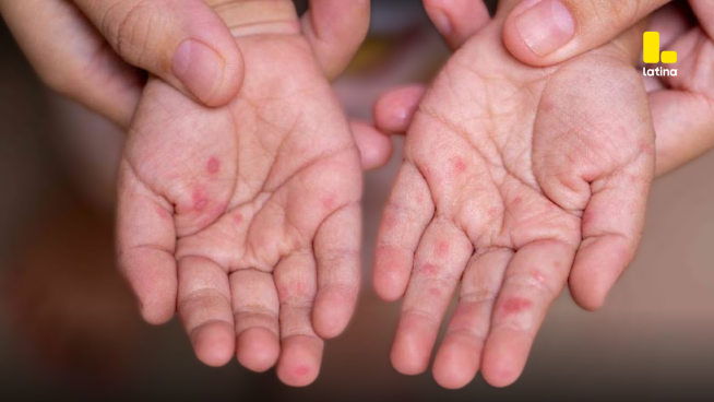 Alerta sanitaria por virus infantil: piden reforzar higiene y prevención
