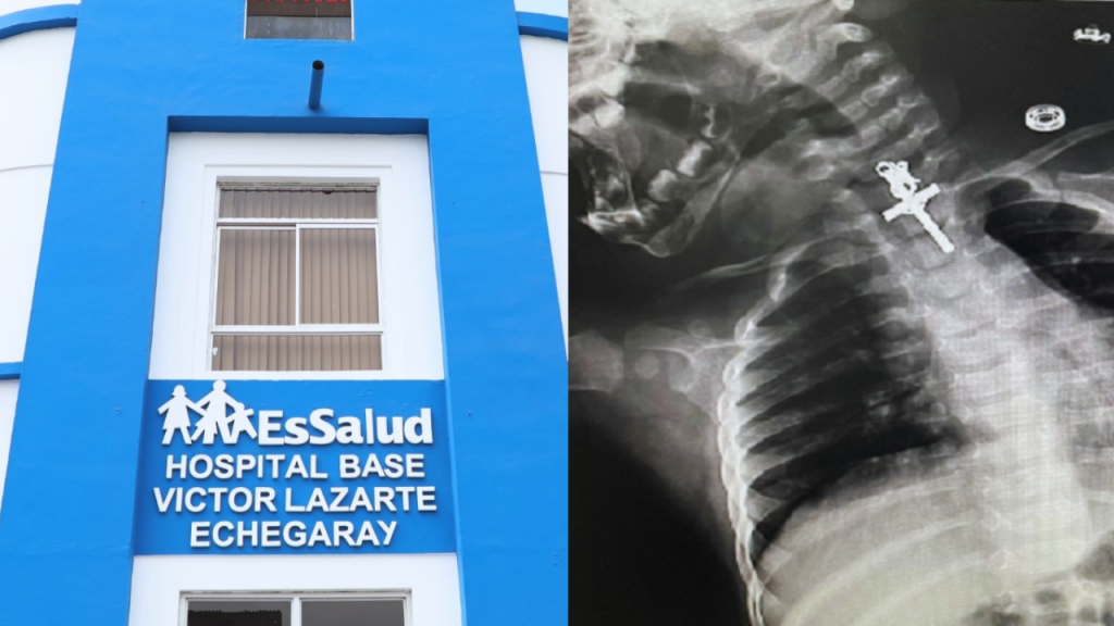 La Libertad: médicos salvan vida de bebé de 10 meses que tenía un crucifijo en su esófago