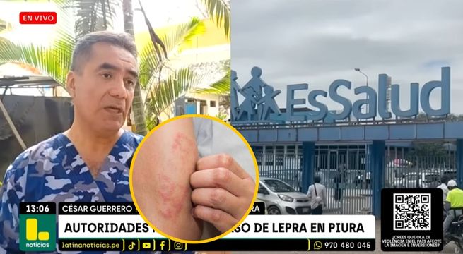 Confirman primer caso de lepra en Perú: médico da detalles sobre monitoreo de paciente